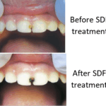 SDF treatment